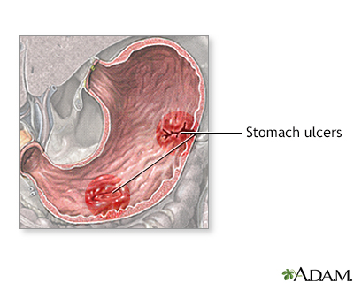 Excess Stomach Acid Mimics Hunger -.